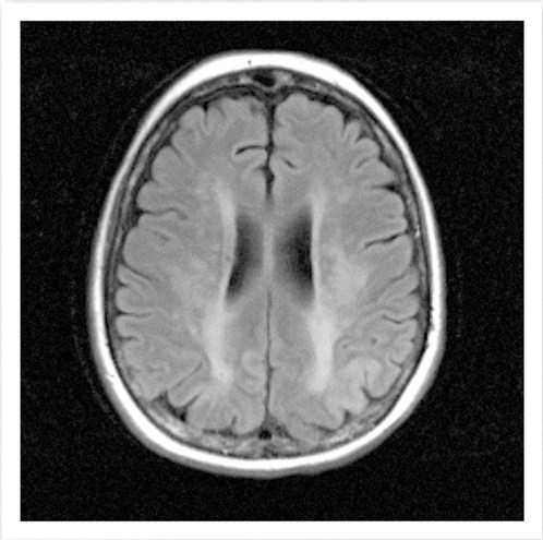 Can You Determine the Cause of This Patient’s Vision Changes?