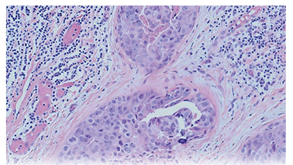 Ductal Carcinoma In Situ: Non-Mass Enhancement on MRI 10 Years Before Mammographic Microcalcifications