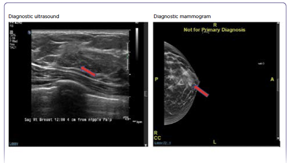 Beyond Standard Endocrine Therapy: A New Adjuvant Treatment in High-Risk Early Breast Cancer