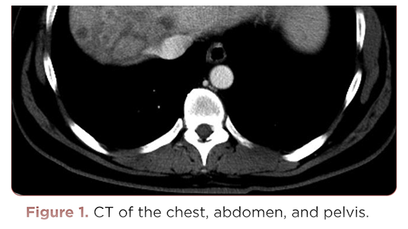 Abdominal Bloating Following a Diagnosis of Aplastic Anemia: Correlation or Red Herring?