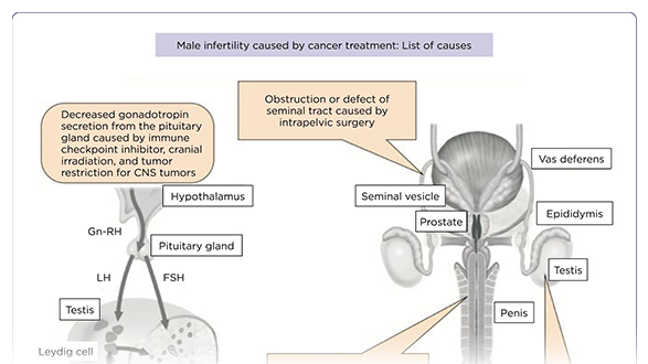Testicular Cancer Survivorship: Navigating Long-Term Health Consequences