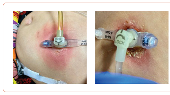 Is it Cellulitis Again? Erythema Concerning for Infection in Children With High-Risk Solid Tumors Who Have a Gastrostomy Tube